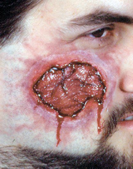 Open Wound Kit